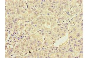 Immunohistochemistry of paraffin-embedded human liver cancer using ABIN7172232 at dilution of 1:100 (TRAF2 anticorps  (AA 147-281))