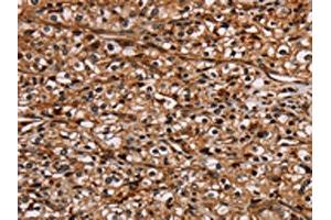 The image on the left is immunohistochemistry of paraffin-embedded Human prostate cancer tissue using ABIN7130441(NOC2L Antibody) at dilution 1/20, on the right is treated with fusion protein.