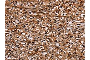 The image on the left is immunohistochemistry of paraffin-embedded Human prostate cancer tissue using ABIN7130441(NOC2L Antibody) at dilution 1/20, on the right is treated with fusion protein. (NOC2L anticorps)
