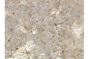 ABIN6254942 and ABIN6267115 at 1/100 staining human lung squamous cell carcinoma by IHC-P. (EIF4G1 anticorps  (pSer1147))