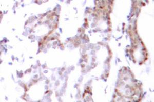 Immunohistochemistry (IHC) analysis of Elk1 antibody in paraffin-embedded human breast carcinoma tissue. (ELK1 anticorps)
