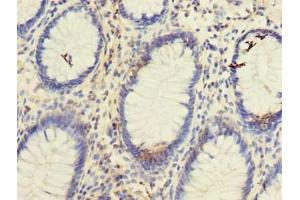 Immunohistochemistry of paraffin-embedded human colon cancer using ABIN7171842 at dilution of 1:100 (TSPAN1 anticorps  (AA 110-211))
