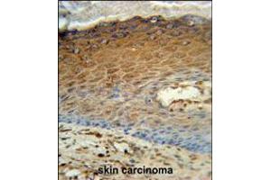 AK7 Antibody immunohistochemistry analysis in formalin fixed and paraffin embedded human skin carcinoma followed by peroxidase conjugation of the secondary antibody and DAB staining. (Adenylate Kinase 7 anticorps  (C-Term))