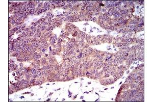 Immunohistochemical analysis of paraffin-embedded ovarian cancer tissues using PDE1B mouse mAb with DAB staining.