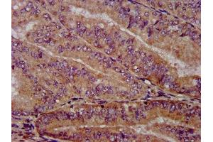 IHC image of ABIN7169262 diluted at 1:1000 and staining in paraffin-embedded human endometrial cancer performed on a Leica BondTM system.
