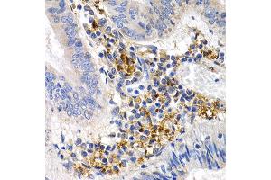 Immunohistochemistry of paraffin-embedded human colon cancer using GDF5 antibody at dilution of 1:200 (400x lens). (GDF5 anticorps)
