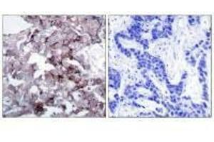 Immunohistochemistry analysis of paraffin-embedded human breast carcinoma tissue, using EGFR (Ab-1172) antibody. (EGFR anticorps  (Tyr1172))