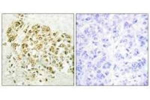 Immunohistochemistry analysis of paraffin-embedded human breast carcinoma tissue using MZF-1 antibody. (MZF1 anticorps  (N-Term))