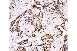 Anti-APLP1 antibody, IHC(P) IHC(P): Human Lung Cancer Tissue