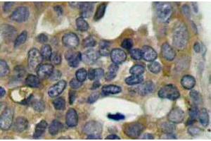 Immunohistochemistry (IHC) analyzes of p-ASK1 antibody in paraffin-embedded human breast carcinoma tissue (ASK1 anticorps  (pSer966))