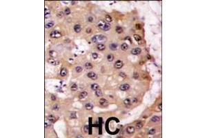 Formalin-fixed and paraffin-embedded human hepatocarcinoma tissue reacted with PSMA5 antibody , which was peroxidase-conjugated to the secondary antibody, followed by DAB staining. (PSMA5 anticorps  (AA 106-135))