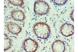 Immunohistochemistry of paraffin-embedded human colon cancer using ABIN7156617 at dilution of 1:100 (IRF2 anticorps  (AA 120-349))