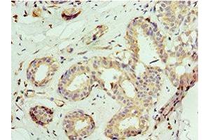 Immunohistochemistry of paraffin-embedded human breast cancer using ABIN7145038 at dilution of 1:100 (ATAD3A anticorps  (AA 1-240))