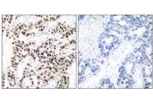 Immunohistochemical analysis of paraffin-embedded human breast carcinoma tissue using Myc (Ab-58) antibody (E021034). (c-MYC anticorps)