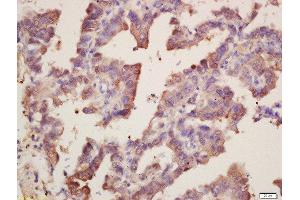 Formalin-fixed and paraffin embedded human lung carcinoma labeled with Rabbit Anti-SOD1 Polyclonal Antibody, Unconjugated  at 1:200 followed by conjugation to the secondary antibody and DAB staining (SOD1 anticorps  (AA 6-100))