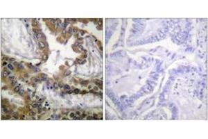Immunohistochemistry analysis of paraffin-embedded human lung carcinoma tissue, using VEGFR2 (Ab-1054) Antibody. (VEGFR2/CD309 anticorps  (AA 1020-1069))