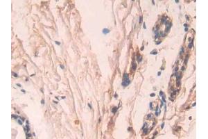 DAB staining on IHC-P; Samples: Human Breast cancer Tissue (Caspase 7 anticorps  (AA 24-198))
