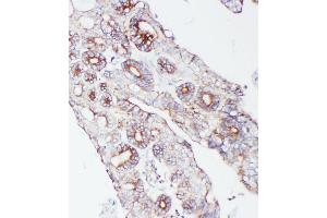 Anti-PCSK9 antibody, IHC(P) IHC(P): Human Intestinal Cancer Tissue (PCSK9 anticorps  (C-Term))