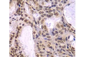 Immunohistochemistry of paraffin-embedded Human oophoroma using POLD3 Polyclonal Antibody at dilution of 1:100 (40x lens).