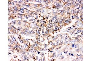 Anti-Smad1 antibody, IHC(P) IHC(P): Human Lung Cancer Tissue (SMAD1 anticorps  (C-Term))
