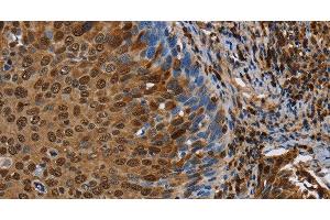 Immunohistochemistry of paraffin-embedded Human cervical cancer tissue using NRP2 Polyclonal Antibody at dilution 1:45 (NRP2 anticorps)