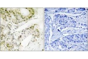 Immunohistochemistry analysis of paraffin-embedded human lung carcinoma, using MED13 Antibody. (MED13 anticorps  (AA 681-730))