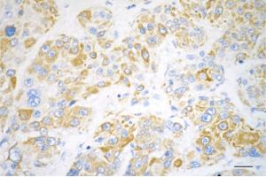 Immunohistochemistry was performed on paraffin-embedded human hepatocarcinoma using DLAT antibody (ABIN7798336), 1:200).