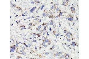 Immunohistochemistry of paraffin-embedded Human gastric cancer using PDCD10 Polyclonal Antibody at dilution of 1:100 (40x lens).