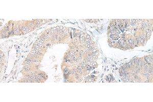 Immunohistochemistry of paraffin-embedded Human colorectal cancer tissue using LYRM2 Polyclonal Antibody at dilution of 1:50(x200)