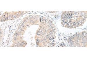 Immunohistochemistry of paraffin-embedded Human colorectal cancer tissue using LYRM2 Polyclonal Antibody at dilution of 1:50(x200) (LYRM2 anticorps)