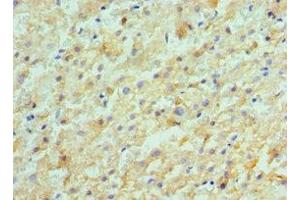 Immunohistochemistry of paraffin-embedded human liver cancer using ABIN7143180 at dilution of 1:100 (ACVR2A anticorps  (AA 20-140))