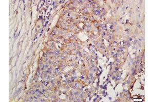 Formalin-fixed and paraffin embedded human lung carcinoma labeled with Rabbit Anti-Factor D/Adipsin Polyclonal Antibody, Unconjugated (ABIN1713782) at 1:200 followed by conjugation to the secondary antibody and DAB staining (Adipsin anticorps  (AA 21-120))
