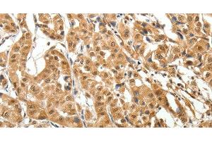 Immunohistochemistry of paraffin-embedded Human lung cancer tissue using MAP1A Polyclonal Antibody at dilution 1:40 (MAP1A anticorps)