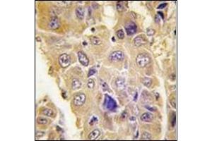 Formalin-fixed and paraffin-embedded human hepatocarcinoma tissue reacted with  Autophagy ATG7 (C-term) followed which was peroxidase-conjugated to the secondary antibody, followed by DAB staining.