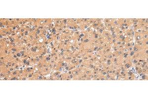 Immunohistochemistry of paraffin-embedded Human liver cancer using AP2A1 Polyclonal Antibody at dilution of 1/20 (alpha Adaptin anticorps)