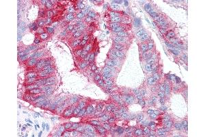 Anti-GPR31 antibody IHC of human Colon, Carcinoma. (GPR31 anticorps  (Extracellular Domain))