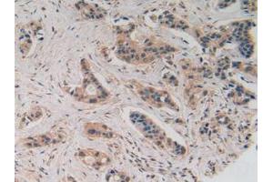 IHC-P analysis of Human Breast Cancer Tissue, with DAB staining. (SLIT2 anticorps  (AA 1416-1528))