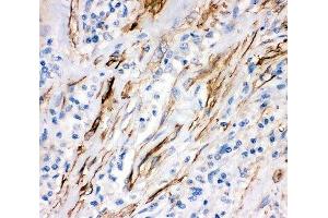 IHC-P: Fas antibody testing of human lung cancer tissue (FAS anticorps  (AA 26-173))