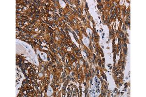 Immunohistochemistry of Human colon cancer using KARS Polyclonal Antibody at dilution of 1:60