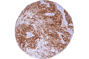 Urothelial carcinoma of the urinary bladder Invasive with moderate to strong TYMS staining of tumor cells (Recombinant TYMS anticorps  (Center))