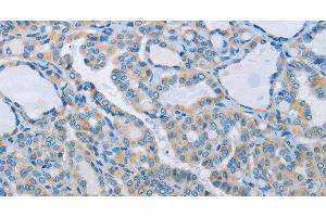 Immunohistochemistry of paraffin-embedded Human thyroid cancer tissue using NEK5 Polyclonal Antibody at dilution 1:60 (NEK5 anticorps)