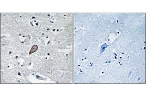 Immunohistochemistry analysis of paraffin-embedded human brain carcinoma tissue, using PKC thet (Ab-538) Antibody. (PKC theta anticorps  (AA 504-553))