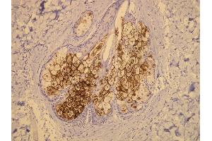 Immunohistochemistry (IHC) image for anti-Mucin 1 (MUC1) (AA 1235-1253), (C-Term) antibody (ABIN870416)