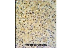 PSME1 Antibody (C-term) (ABIN651448 and ABIN2840245) IHC analysis in formalin fixed and paraffin embedded hepatocarcinoma followed by peroxidase conjugation of the secondary antibody and DAB staining. (PSME1 anticorps  (C-Term))