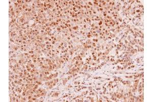 IHC-P Image MAD2L1 antibody [C2C3], C-term detects MAD2L1 protein at cytoplasm and nucleus in human A549 xenograft by immunohistochemical analysis. (MAD2L1 anticorps  (C-Term))