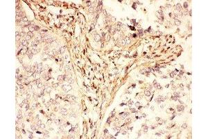 IHC-P: LIF antibody testing of human lung cancer tissue (LIF anticorps  (AA 23-202))