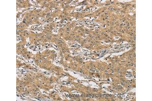 Immunohistochemistry of Human liver cancer using AMZ2 Polyclonal Antibody at dilution of 1:60 (AMZ2 anticorps)