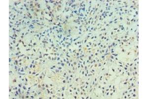 Immunohistochemistry of paraffin-embedded human breast cancer using ABIN7167500 at dilution of 1:100 (PTPRA anticorps  (AA 20-142))