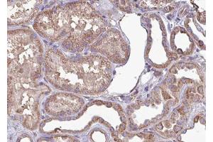 ABIN6267702 at 1/100 staining human kindey carcinoma tissue sections by IHC-P. (CAMK2B anticorps  (pThr286))