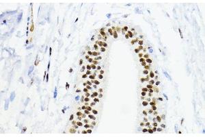 Immunohistochemistry of paraffin-embedded Human mammary cancer using ZEB1 Polyclonal Antibody at dilution of 1:200 (40x lens). (ZEB1 anticorps)
